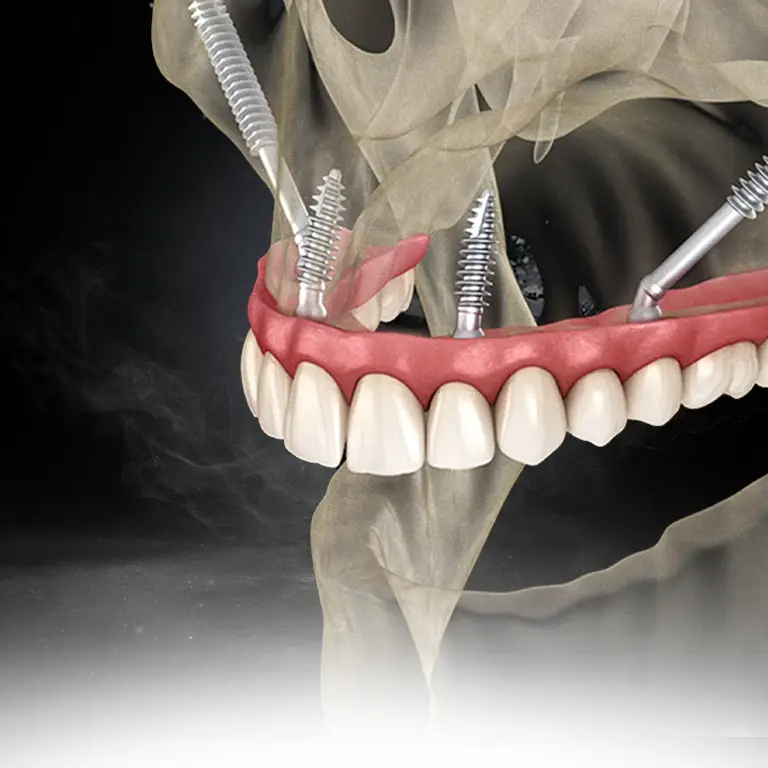 Zygomatıc Implants